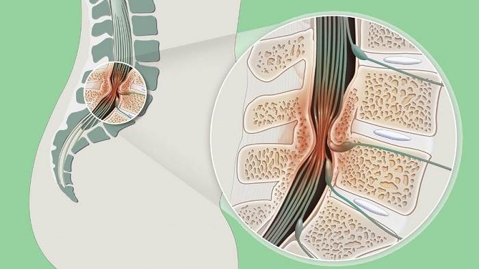 5 دلیل اصلی تنگی کانال نخاعی