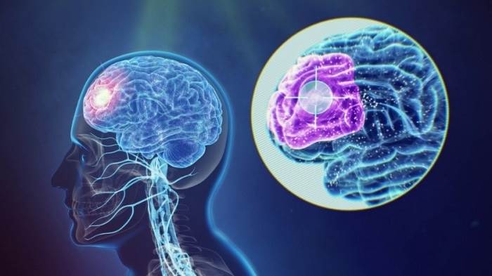 موارد استفاده تحریک مغناطیسی مغز